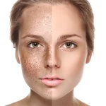 Vodič za kožu bez pega: Kako se rešiti hiperpigmentacije